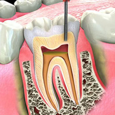 Endodontics