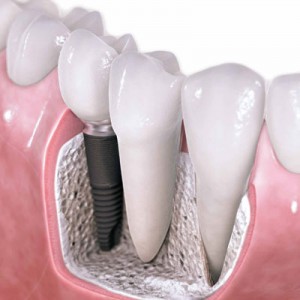 Periodontic Services