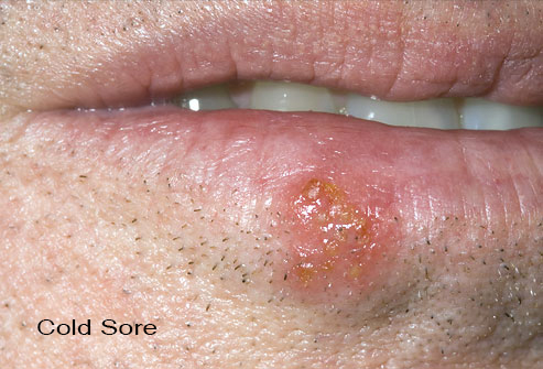 cold sore, apthous ulcers